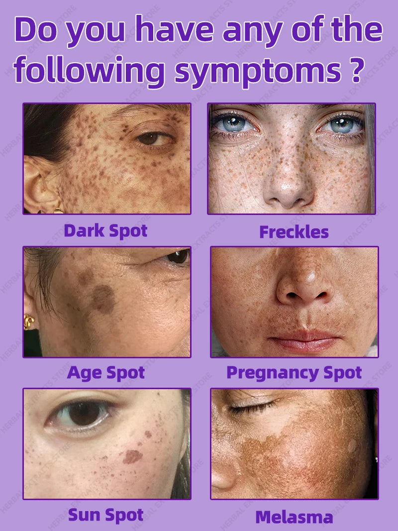 Freckles Removal - My Store