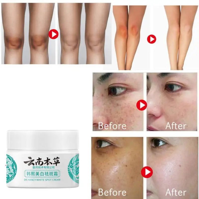 Yunnan Herbal Whitening Freckle Removal Cream